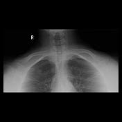 apicolordotic view fit to work|apical lordotic view.